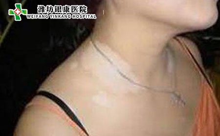 女性白癜風病因,女性更年期白癜風